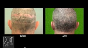 before and after body hair to head transplantation