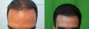 Why An FUE Should Be Your Top Option As A Hair Transplant Procedure