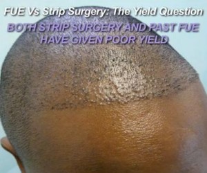 FUE and Restoring Strip Scar Surgery 