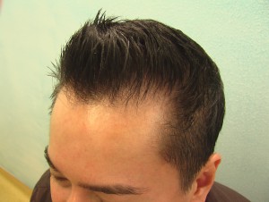 Asian hairline after FUE repair