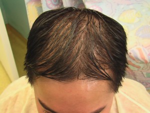 Asian FUE hair transplant