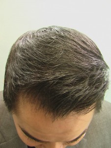 after Asian FUE Hair Transplant Surgery using 1500 grafts
