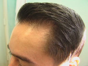 Asian hairline refinement by FUE