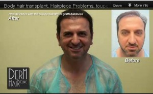 Skilled Hair Surgeon Vs Automated FUE Technology. Dr U's Body hair transplant patient