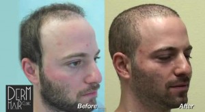 UGraft Advanced FUE Hair Transplant using 5800 grafts before and after