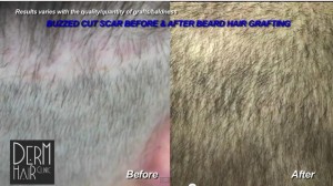 UGraft Advanced FUE Hair Transplant using 5800 grafts repairs Strip Surgery Scar 