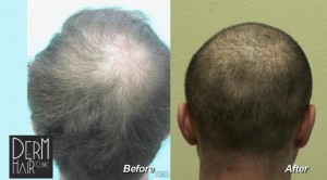 Density added to Crown of Head by UGraft Advanced FUE Hair Transplant using 5800 grafts