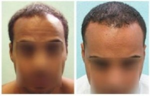 African American Hair Loss Patient 