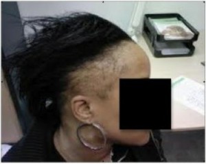 Traction Alopecia - Hair Loss From Hair Styling