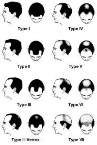 Hamilton Norwood illustration of how male pattern baldness progresses