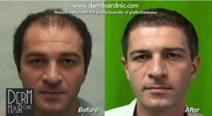  Achieving Natural Hairline Restoration : Before and after results of FUE hair transplant with uGraft