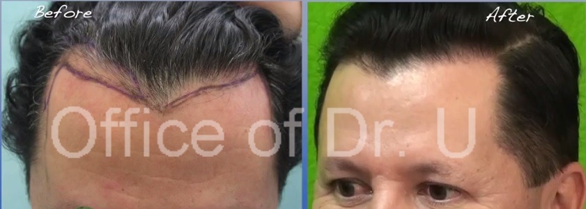 Widow's Peak Hairline Repair with UGraft FUE