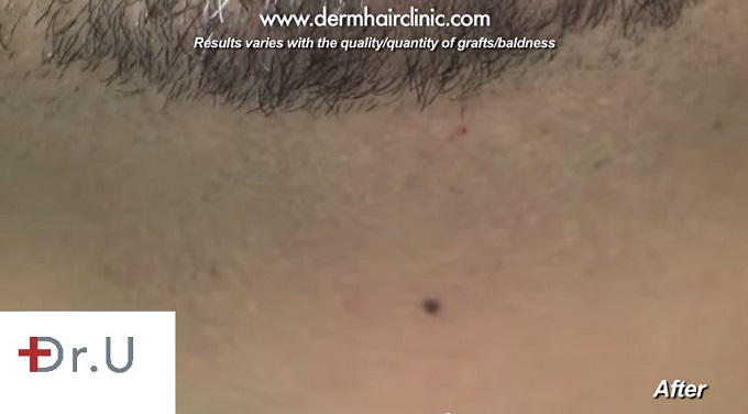 Close up of beard donor area| Best healing results