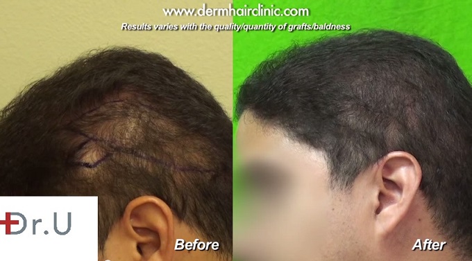 Body hair transplant repair of shock loss