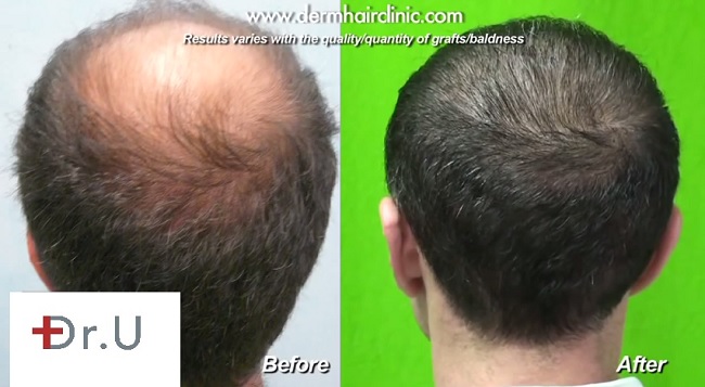 hair restoration for the crown before and after 