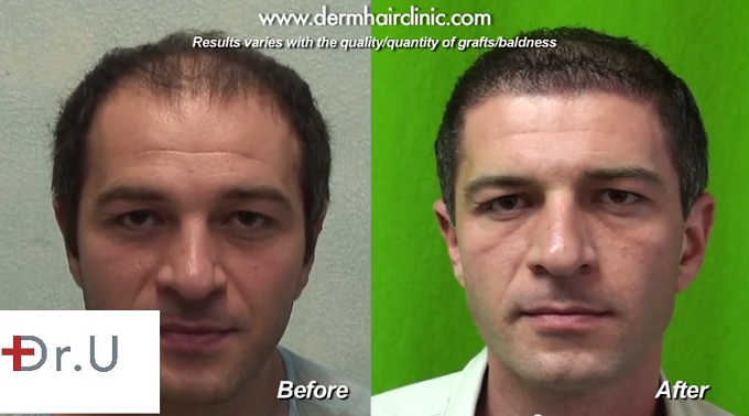 New Hairline and Temples| Body Hair Transplant -Side by Side Comparison