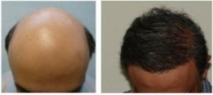 Is there A Cure For Hair Loss?, in this patient body hair transplant by UGraft through Dr U is his hair loss cure