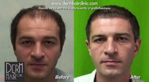 When to Consider Body Hair Transplantation