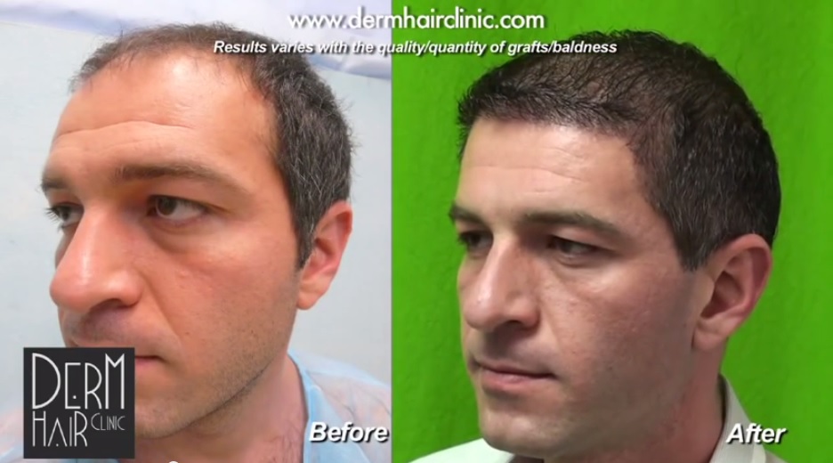 BHT Results - Hairline and Crown Restoration With 10,000 Grafts
