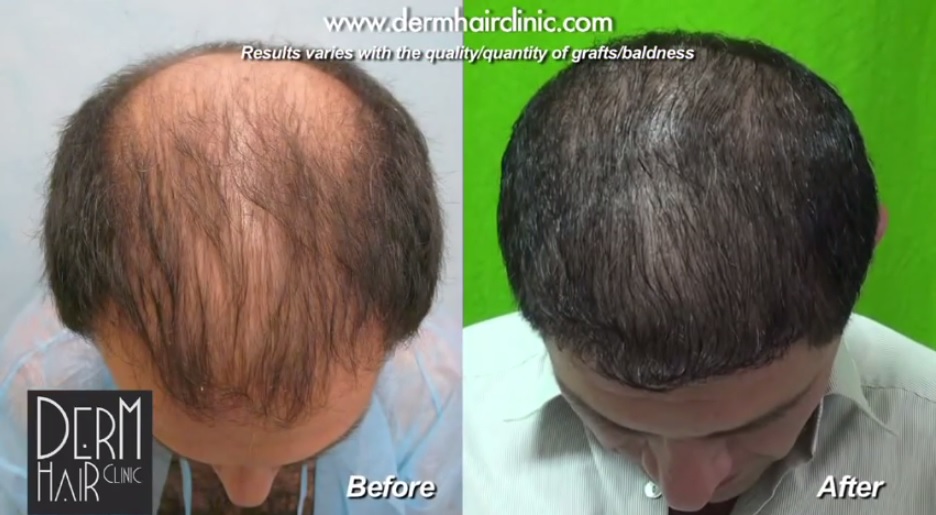 hair restoration expectations regarding coverage level must be discussed at consultation