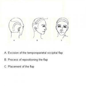 Hair Restoration and Temporoparieto Occipital Flap Surgery 