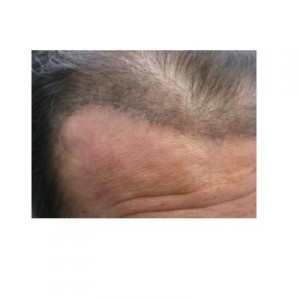 temporoparietal occipital hair flap surgery resulted in a line of scar in hairline, backward facing hairs 