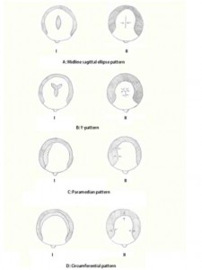 Scalp Reduction diagram