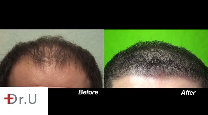 Restoration of Patient's Hairline| Before & After Photos