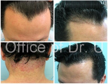 Widow’s Peak Hairline Repair with UGraft FUE before and after