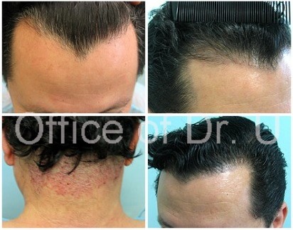 Widow’s Peak Hairline Repair with UGraft FUE before and after Widow’s Peak Hairline Repair with UGraft FUE before and after