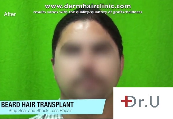 Satisfied Beard Hair Transplant Patient| Sharing Experience