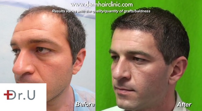 UGraft FUE hair transplant for Level 6 baldness | Before & After - Three Quarters View of Face