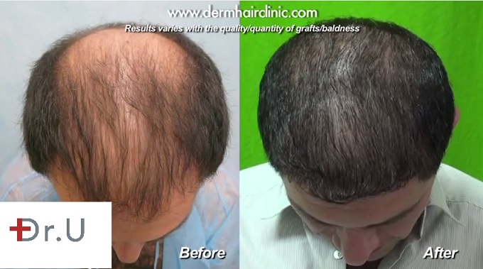 UGraft FUE hair transplant for Level 6 baldness - Before and After