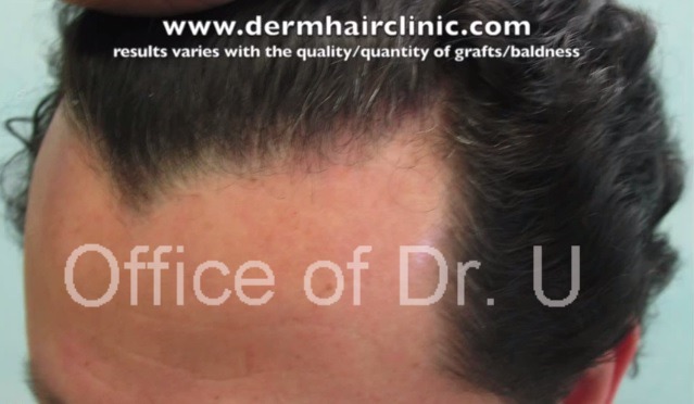 Sharp Central Hairline Peak| FUE Patient