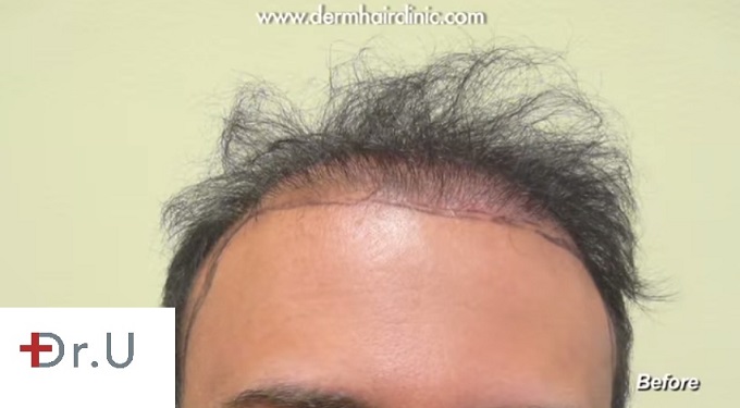 Botched Hair Restoration Results| Poorly Inserted Grafts - Before BHT Repair