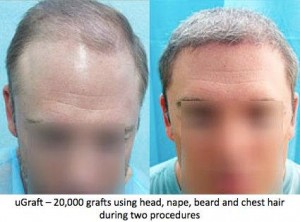 Body hair transplant gave excellent results in this patient