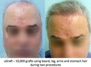 before and after Large Volume FUE Body Hair Transplant Procedures performed by Dr. Umar