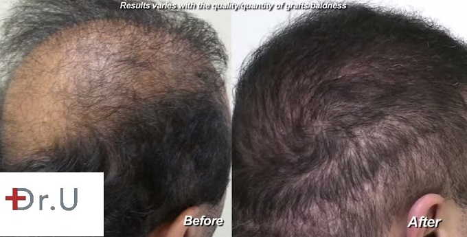 Repairing Crown Hair Loss & Scars| 9000 BHT Grafts - Before and After