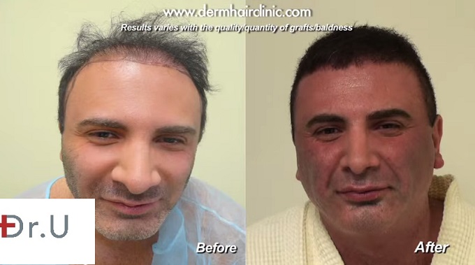 Body Hair Transplant Using 9,000 UGrafts