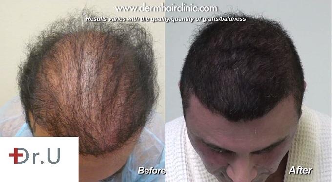 Top of Scalp| Before and AfterBody Hair Transplant Using 9,000 UGrafts