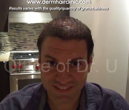 Successful Hair Transplant Repair| Results With 12500 BHT Grafts