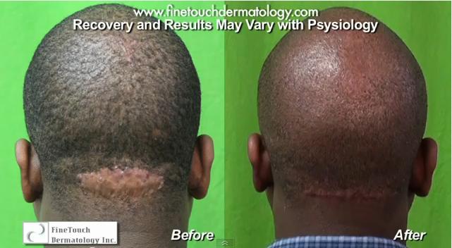 Patient before and after his AKN removal