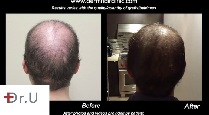 Patient's Crown Area| Transplantation of 12500 BHT Grafts