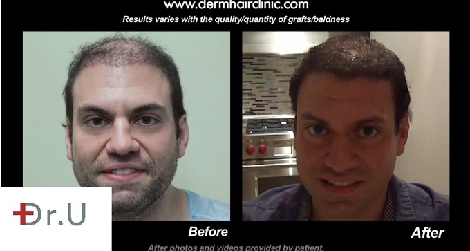 Body Hair Transplant Repair with 12,500 Grafts, Front Facial View of Patient's Results.