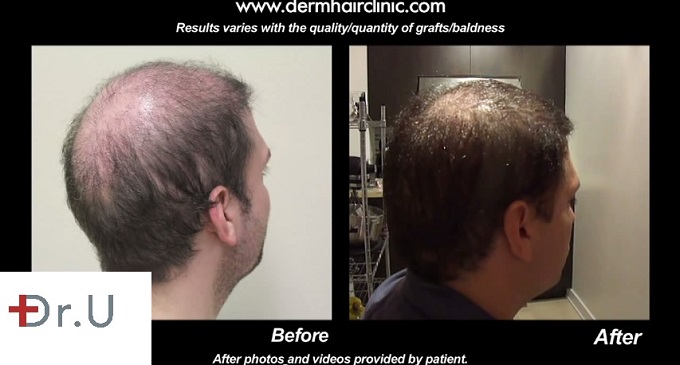 Back and Side View| Patient's Scalp Before & After Beard Hair Transplant