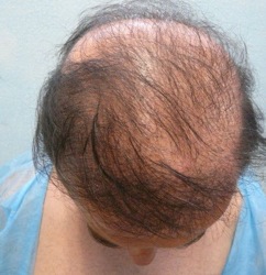 FUE hair transplant cost 5 FUE Hair Transplant Cost 5