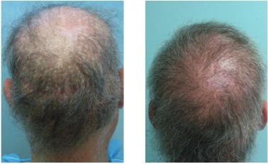 FUE hair transplant pictures| Fixing Punch Graft & Strip Surgery Scars FUE Hair Transplant Pictures|Botched Results