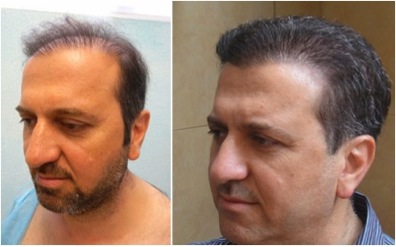 FUE Hair Transplant Pictures|Before & After Body Hair Transplant 