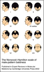 Beard Hair To Head Transplant|Degrees of Baldness|Hamilton Norwood Scale
