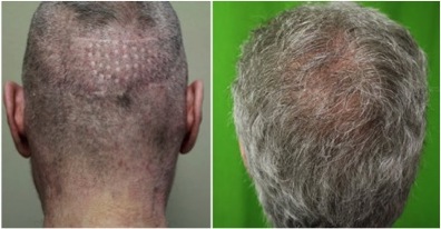beard hair to head transplant |Repairing Botched Surgery Results Beard Hair To Head Transplant |Punch Graft Repair